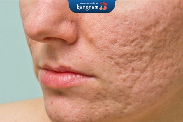 Sẹo lõm có dạng chân hộp vuông với dọc hai bên dốc hơn