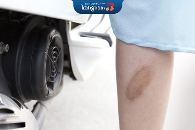 Sẹo thâm bỏng khá cứng đầu, khó xử lý triệt để