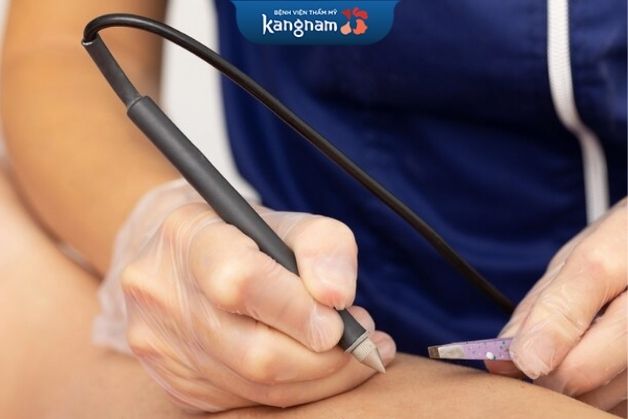 Tẩy lông bằng phương pháp điện phân