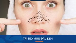 Bí quyết Đánh bay sẹo mụn đầu đen tận gốc, lấy lại làn da mịn màng chỉ trong 7 ngày