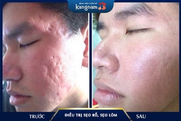 Xóa sẹo đến 95%