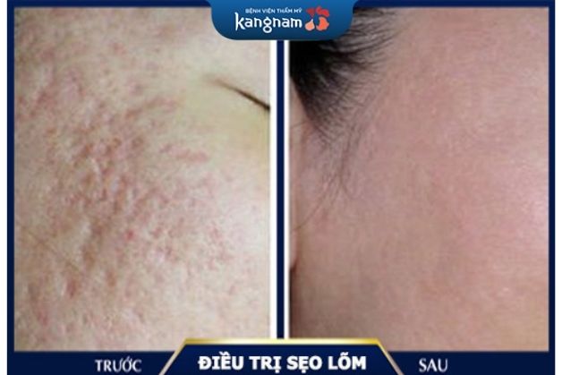 Đánh bay sẹo rỗ, sẹo lõm, trả lại làn da láng mịn