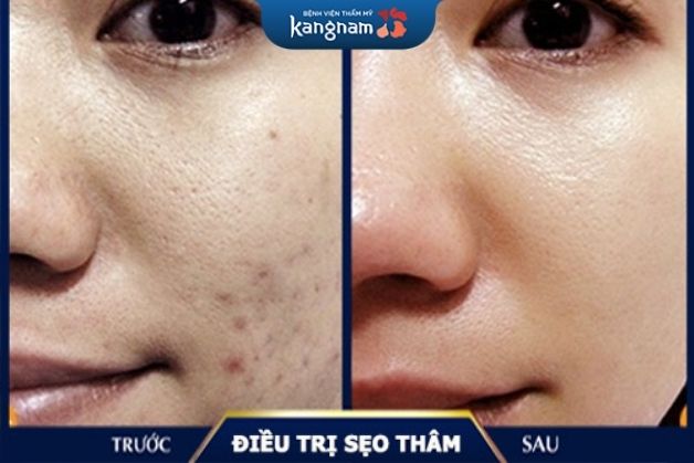 Xóa sạch đến 95% sẹo thâm