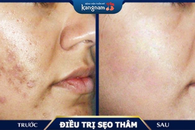 Scar Nano sử dụng các tia sáng laser, tiếp cận sau vào trong lớp bì