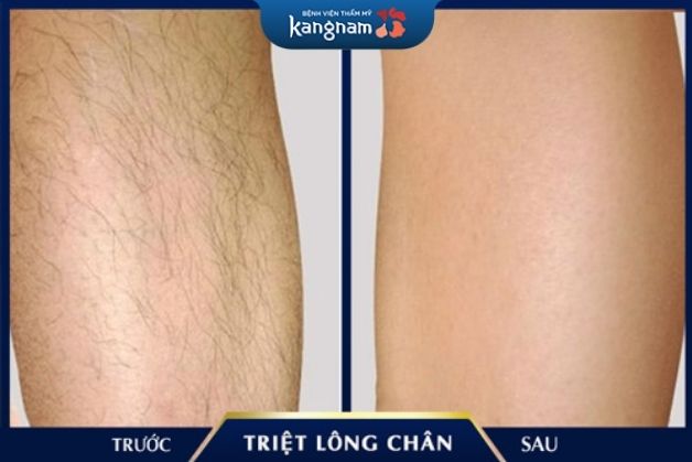 Triệt lông hiệu quả tại Kangnam