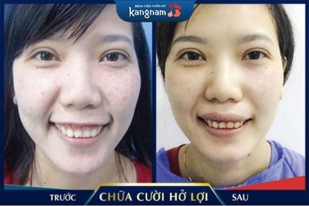 Sự thay đổi ngoạn mục trước và sau khi cắt lợi