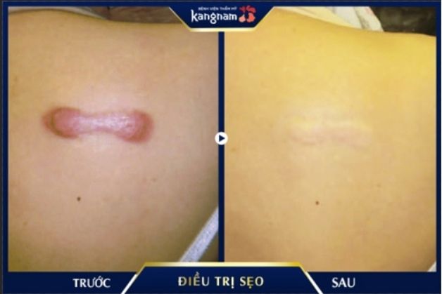 Trị sẹo thâm an toàn và hiệu quả tại Kangnam