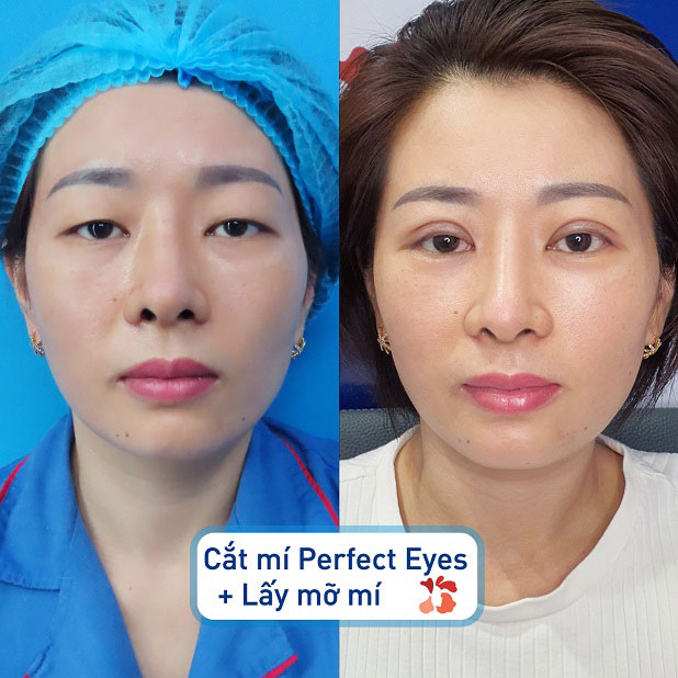 Đường mí tự nhiên như chưa hề có sự can thiệp thẩm mỹ