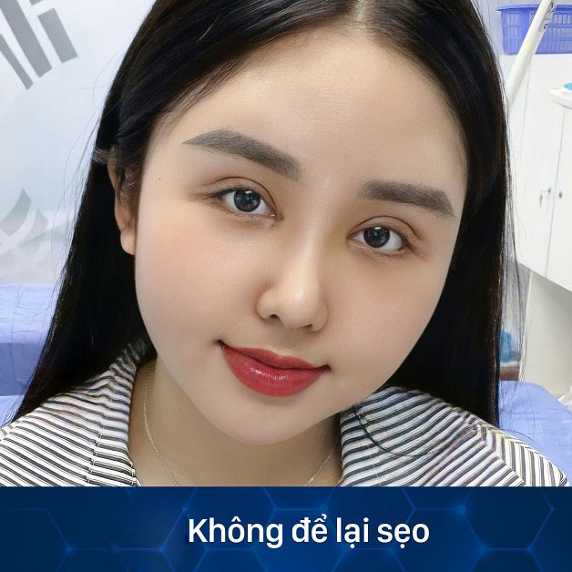 Cắt mí Perfect Eyes không để lại sẹo xấu