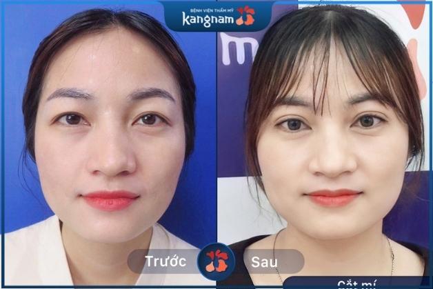 Nếp mí rõ ràng, sắc nét giúp nổi bật các ưu điểm trên gương mặt