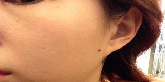 Nốt ruồi trên má gần tai 