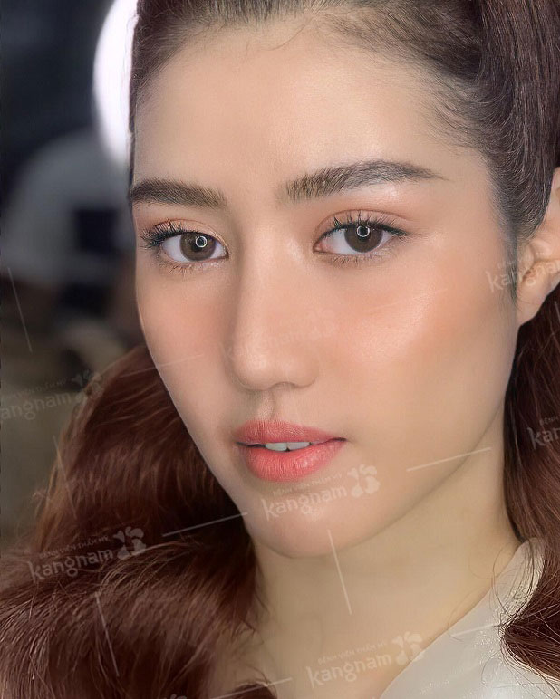 Cắt mí mắt Perfect Eyes công nghệ mới nhất tại Kangnam