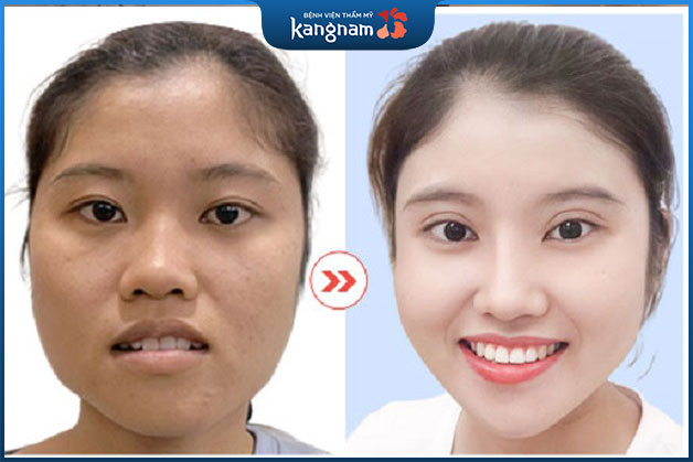 Tạm biệt cằm bạnh, cằm vuông