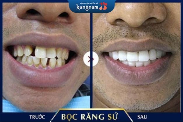 Trồng răng sứ tại Bệnh viện thẩm mỹ Kangnam