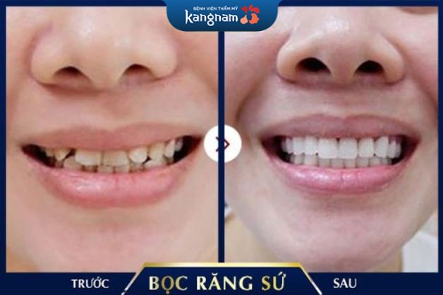 Bọc răng an toàn, không đau đớn