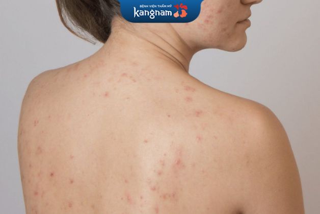 Mụn đầu đen, đầu trắng, mụn mủ, nặng hơn là u nang