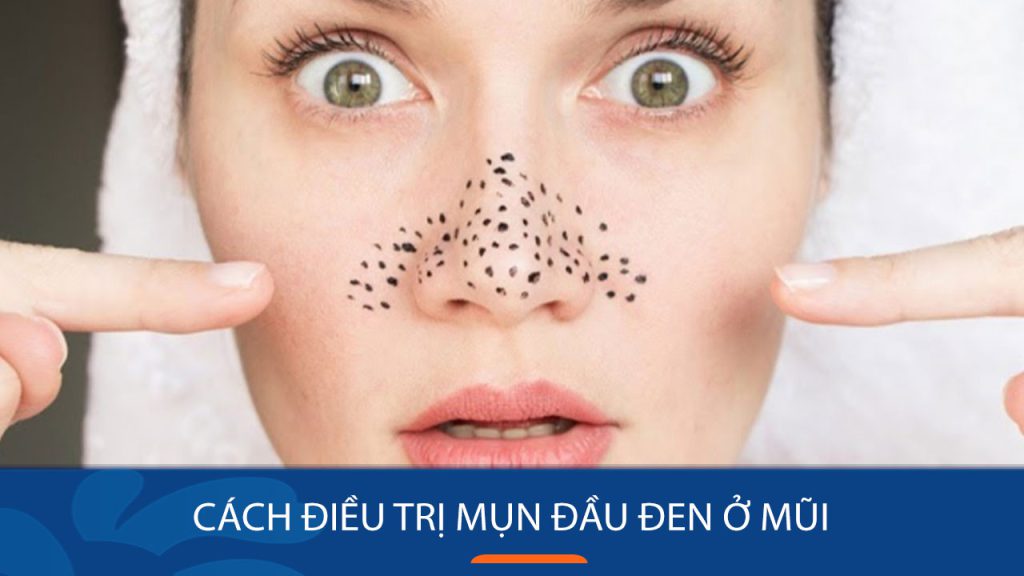 Bí quyết LOẠI BỎ MỤN ĐẦU ĐEN VĨNH VIỄN chỉ với 5 bước đơn giản