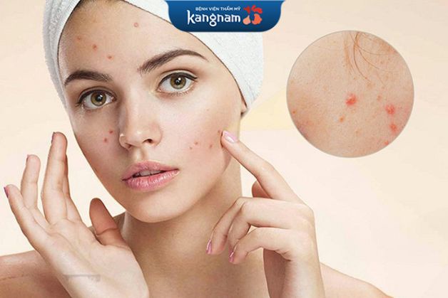 Cân nhắc chi phí khi điều trị mụn