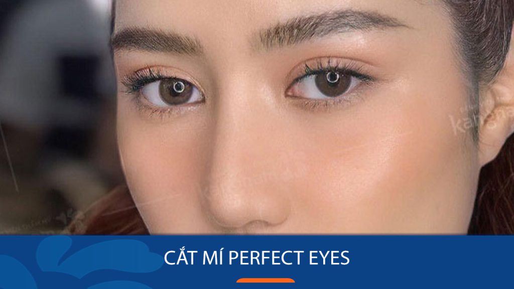 Cắt mí Perfect Eyes là gì? Đối tượng phù hợp & điểm khác biệt