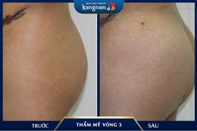 Cấy mỡ hông Kangnam