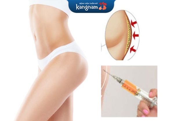 Cấy mỡ hông là phương pháp làm đầy phần hông bằng mỡ tự thân