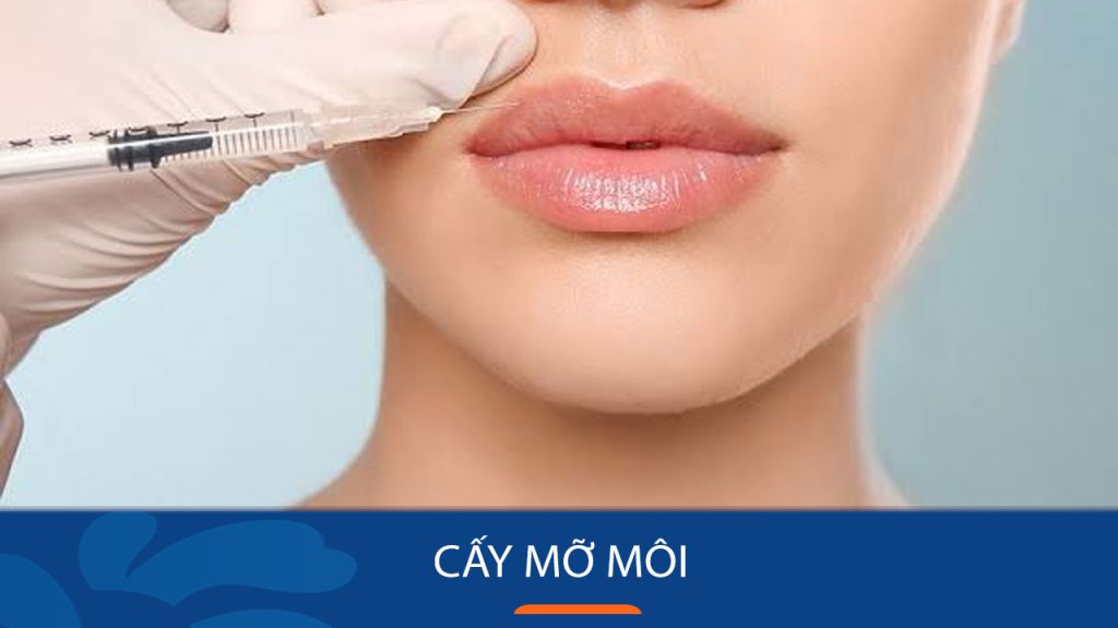 Cấy mỡ môi – Giải pháp hoàn hảo cho đôi môi căng mọng, quyến rũ