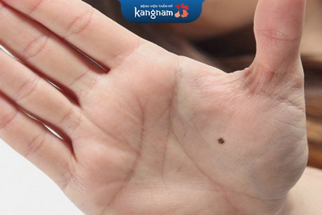 Bạn có thể tây nốt ruồi hoặc không theo ý muốn