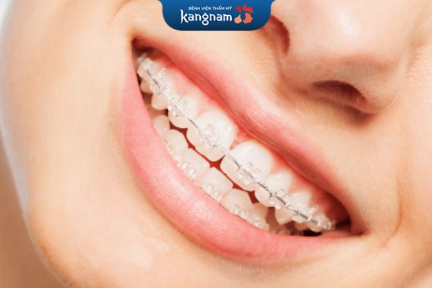 Đảm bảo kết quả niềng tối ưu