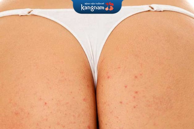 Điều trị mụn mông