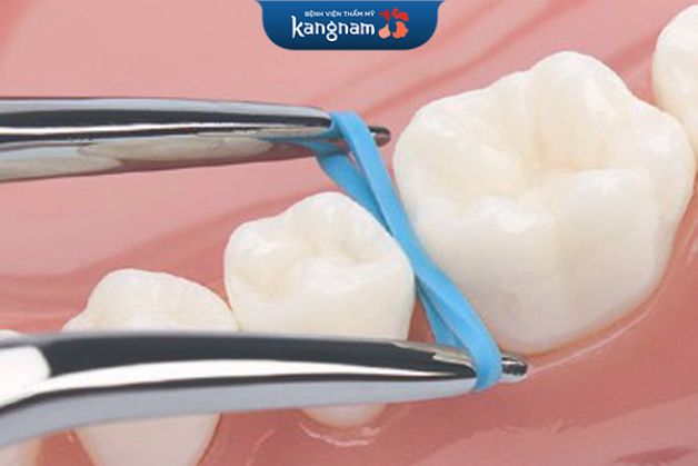 Niềng răng có đau không