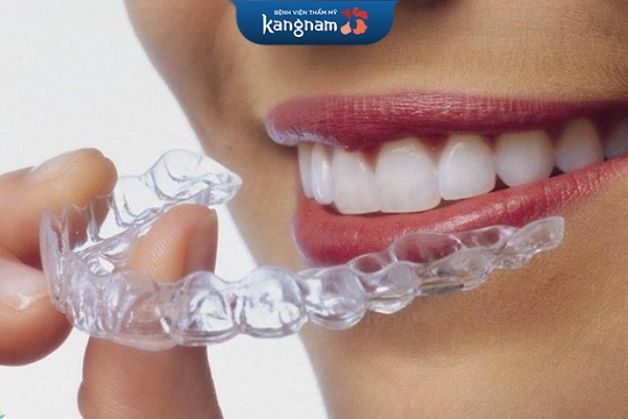 Đeo khay niềng tạo lực đẩy cho răng 