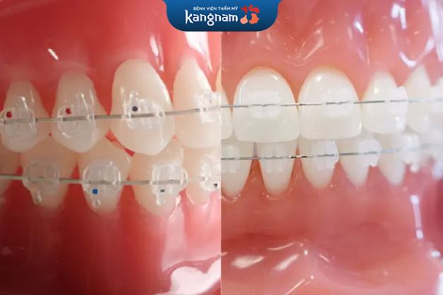 mắc cài sứ và pha lê đều là phương pháp niềng mang tính thẩm mỹ cao