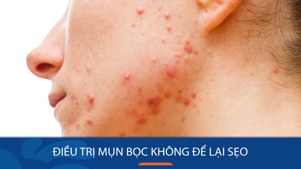 Bí quyết trị mụn bọc tận gốc, không lo sẹo thâm