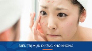 Điều trị mụn dị ứng: Giải pháp dứt điểm cho làn da mịn màng