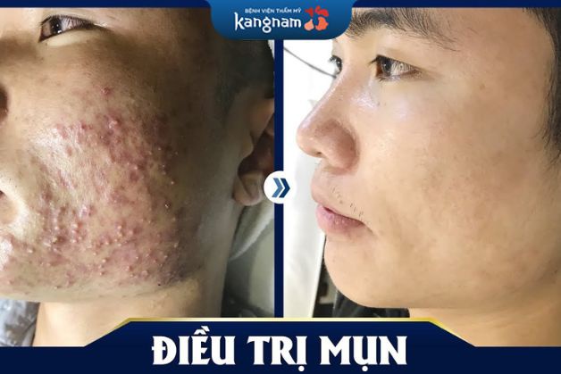 Loại bỏ 95% các loại mụn trên da
