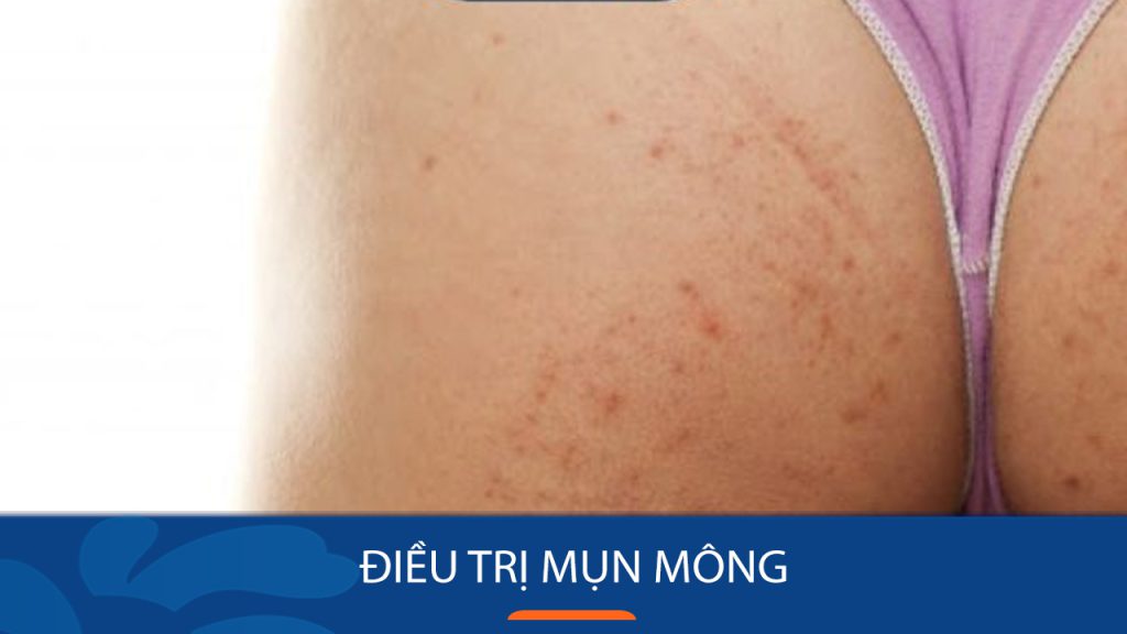 Điều trị mụn mông dứt điểm: Bí quyết đánh bay mụn mông hiệu quả 100%