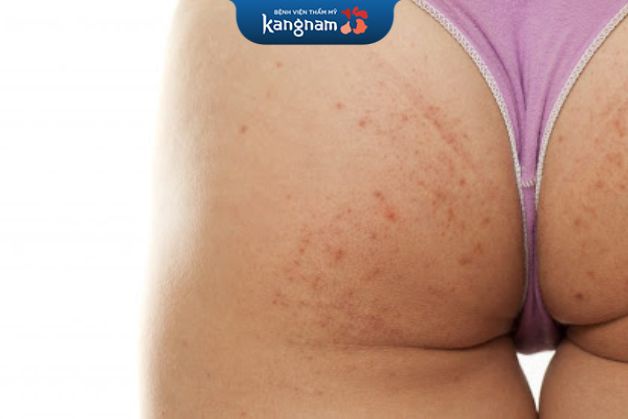 Hạn chế tư thế ngồi để tránh đè vào nốt mụn, khiến vùng da bị tổn thương