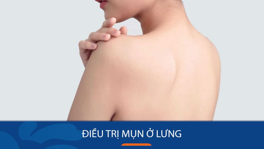 Điều trị mụn ở lưng: Bí quyết trị dứt mụn ở lưng tận gốc