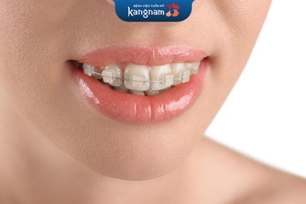 Những người có răng móm, hô, lệch lạc, khấp khểnh, phù hợp chỉnh nha pha lê