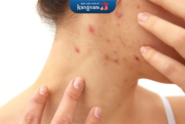 Laser trị mụn cho đối tượng có mụn thịt, mụn thâm sẹo