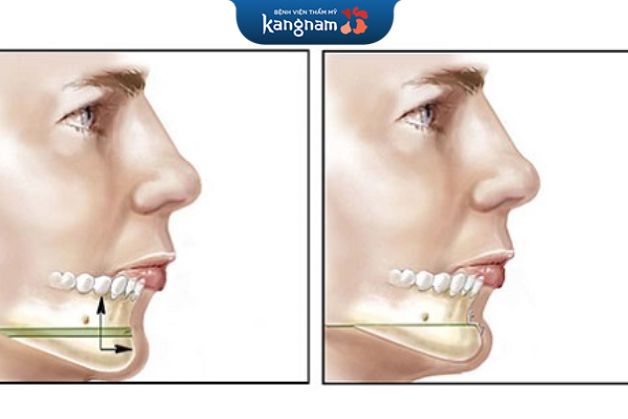 Có thể ăn uống và sinh hoạt dễ dàng sau quá trình phẫu thuật