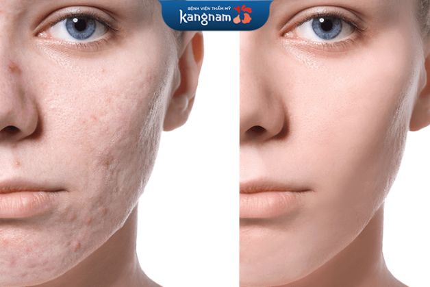 Dùng laser trị mụn nhanh chóng