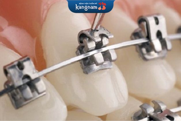 Bác sĩ gắn từng mắc cài niềng răng cẩn thận
