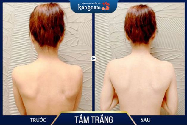 Trị tận gốc mụn lưng, ngăn ngừa mụn tái phát