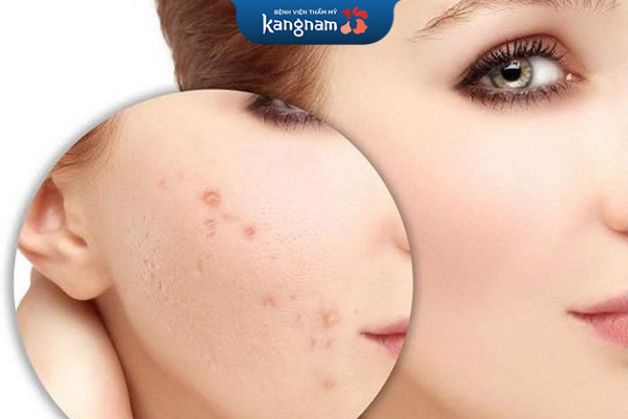 Điều trị mụn đầu đen bằng laser chỉ tác động vào vùng da có mụn, không làm ảnh hưởng đến những vùng da khác