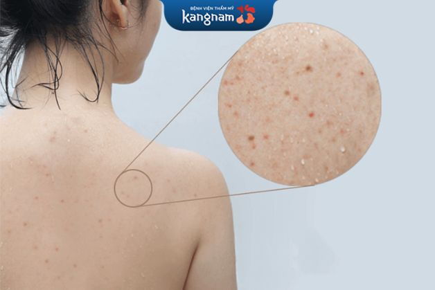 ma sát vào lưng như đeo ba lô, nẹp lưng, dụng cụ thể thao