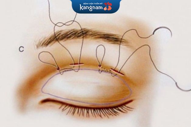 Kỹ thuật bấm mí mắt cho nam sẽ đòi hỏi sự tỉ mỉ, mang tói sự cân đối và nam tính