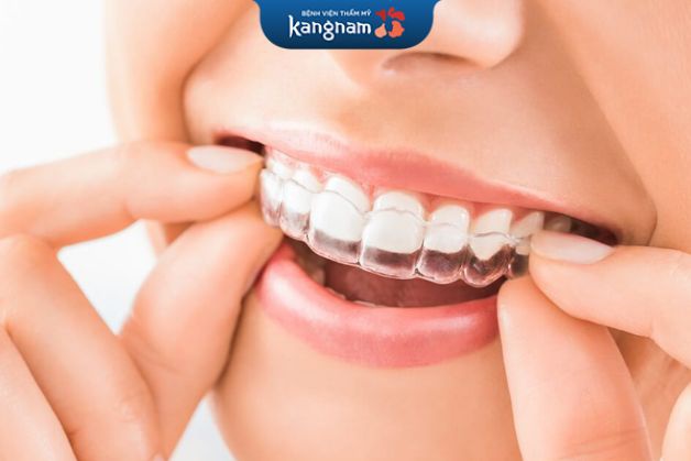 Quá trình niềng răng đơn giản và không cần quá nhiều thời gian chuẩn bị