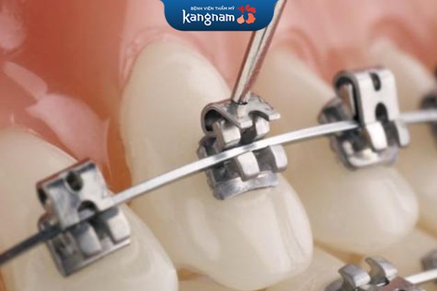 Mắc cài tự buộc có nhiều ưu điểm vượt trội