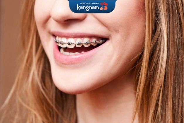 Mắc tài kim loại tự động giúp rút gọn thời gian niềng